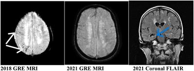 Pathogenesis of cerebral amyloid angiopathy caused by chaotic glymphatics—Mini-review